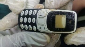 فريق طبي بأسيوط ينجح في استخراج هاتف من معدة مريض