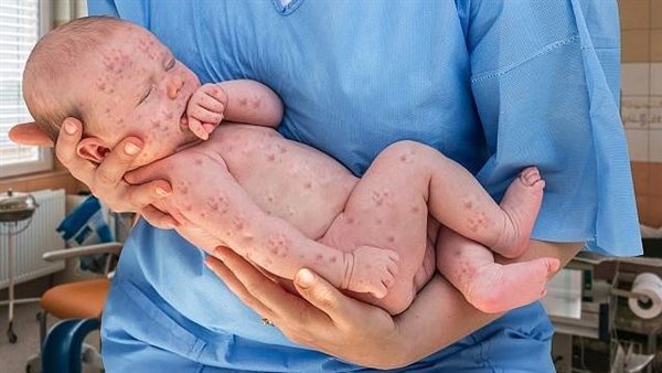 كندا تسجل وفاة رضيع بالحصبة.. والسلطات: الأم لم تتلق اللقاح