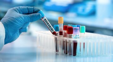 السبب الخفي للقلب والجلطات.. معلومات ماتعرفهاش عن تحليل الهوموسيتين والاستعداد له